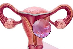 HPV شایع‌ترین عفونت مقاربتی جهان؛ هشدار متخصصان درباره پیامدهای خاموش این ویروس